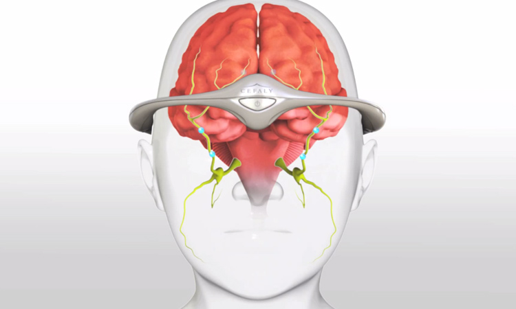 des-chercheurs-ont-elabore-un-bandeau-a-impulsions-electriques-pour-guerir-vos-migraines-intempestives-une