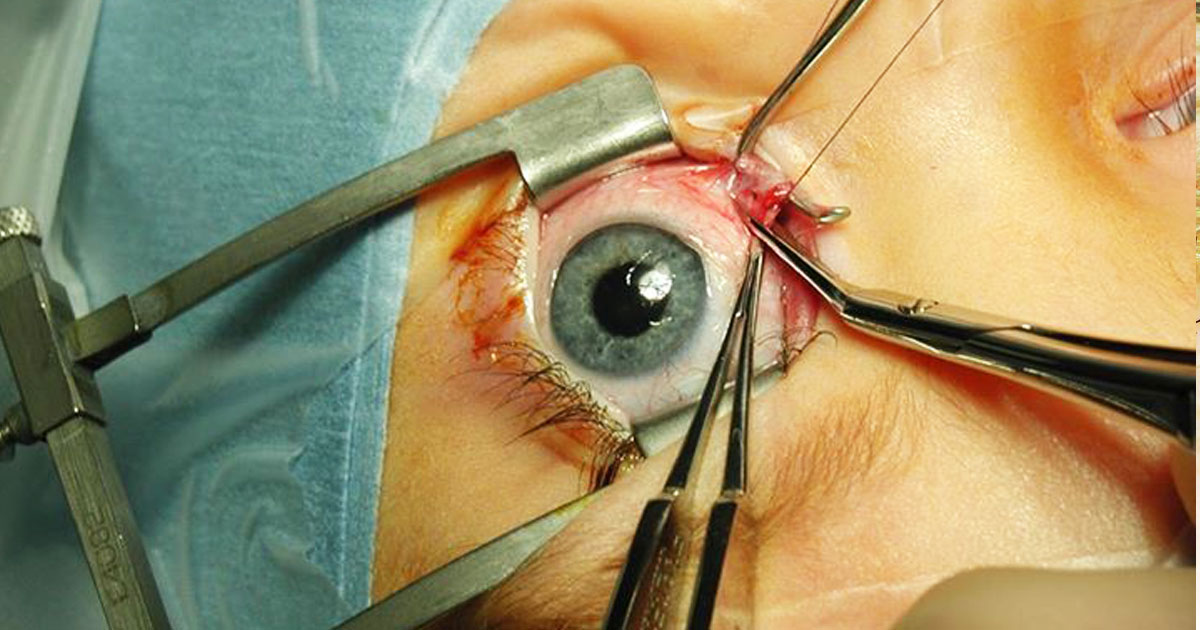 oeil-chirurgie-cellules-souches-une