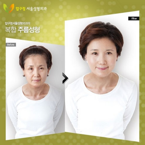 avantapres-31-photos-completement-folles-de-chirurgie-esthetique-en-coree-du-sud14