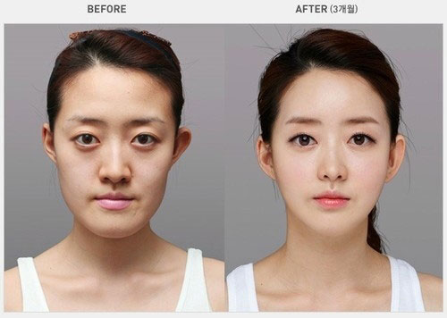 avantapres-31-photos-completement-folles-de-chirurgie-esthetique-en-coree-du-sud15