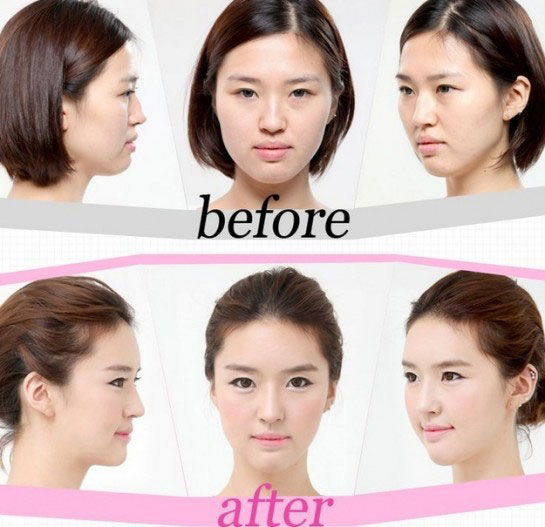 avantapres-31-photos-completement-folles-de-chirurgie-esthetique-en-coree-du-sud20