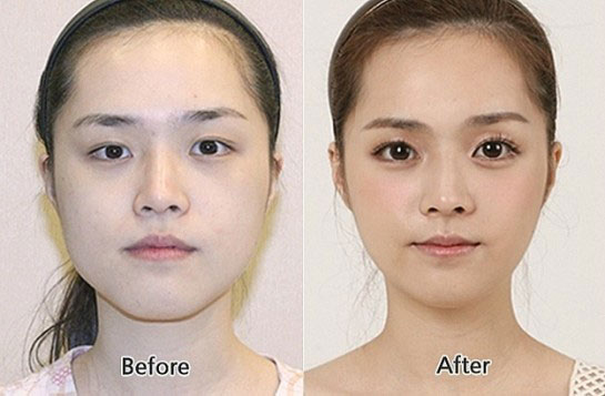 avantapres-31-photos-completement-folles-de-chirurgie-esthetique-en-coree-du-sud22