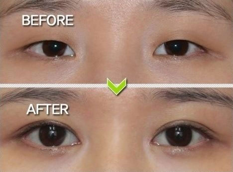 avantapres-31-photos-completement-folles-de-chirurgie-esthetique-en-coree-du-sud8