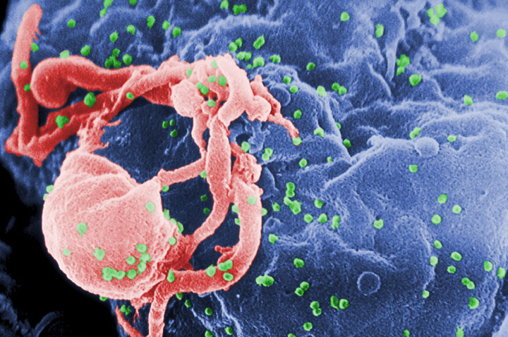 des-chercheurs-francais-parviennent-a-eliminer-les-reservoirs-du-virus-du-sida-dans-le-corps2