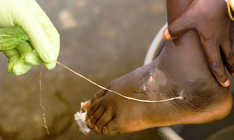 la-dracunculose-un-ver-parasite-absolument-horrifiant-qui-elit-domicile-dans-le-corps-humain-une