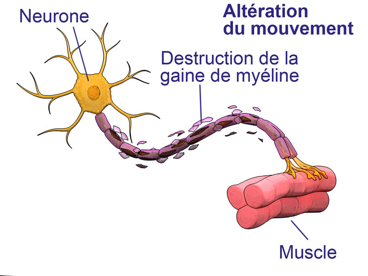 sclerose-en-plaque1