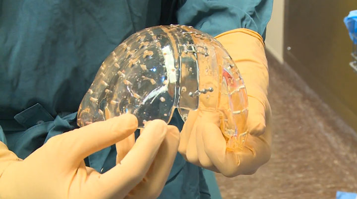 la-premiere-implantation-dun-crane-en-plastique1