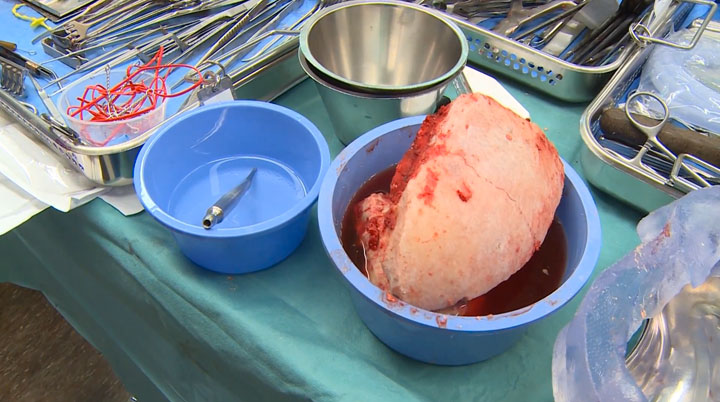 la-premiere-implantation-dun-crane-en-plastique7