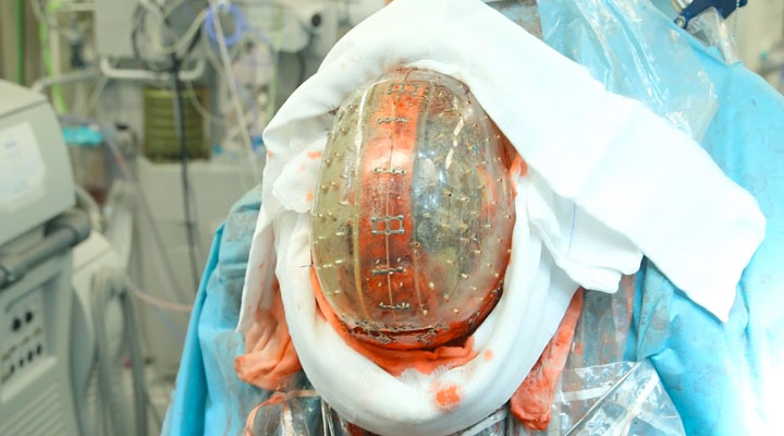 la-premiere-implantation-dun-crane-en-plastique8