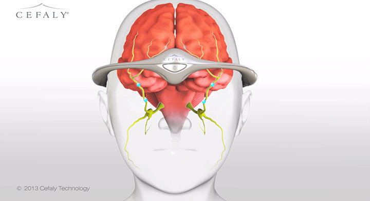 ce-bandeau-electronique-soigne-les-migraines-de-facon-tres-efficace4