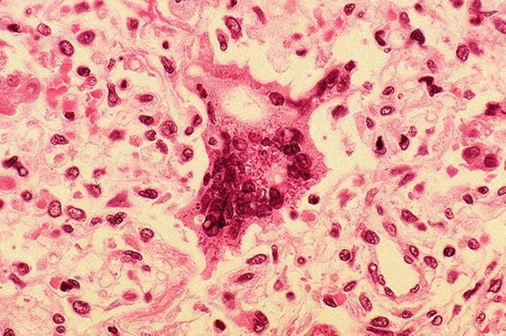 cancer-guerison-virus-rougeole1
