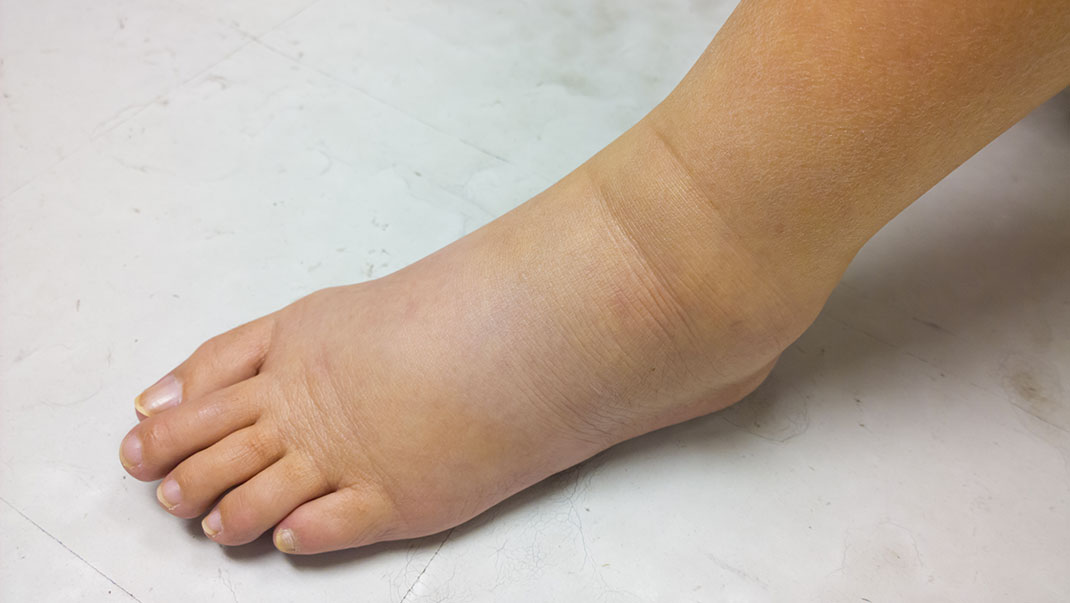 Jambes-gonflées-shuttestock