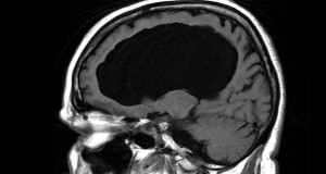 UNE-CERVEAU